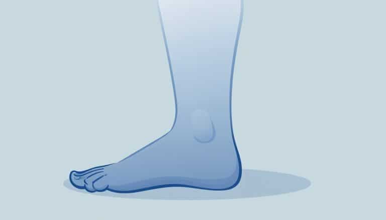 Genou vu de profil avec un gonflement bleu au-dessus de la rotule.
