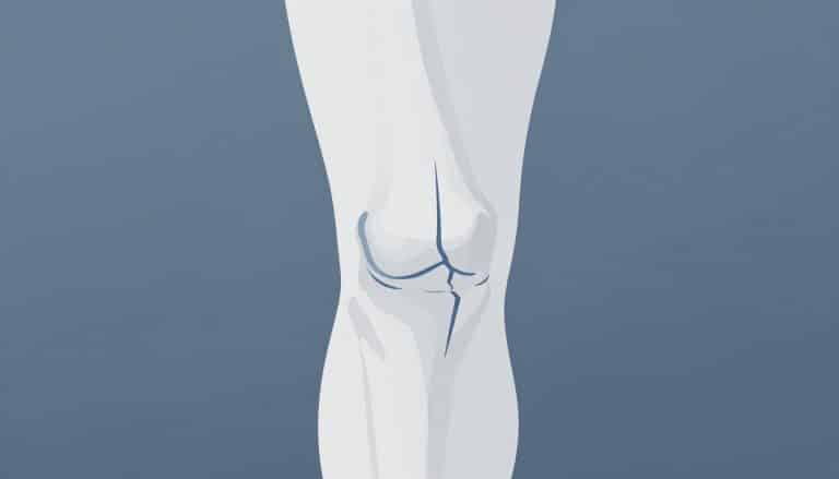 Illustration d’un genou montrant une fissure verticale du ménisque interne.